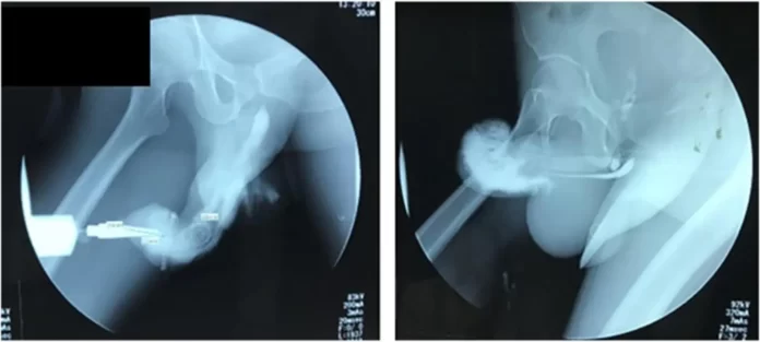 co se může stát vašemu penisu